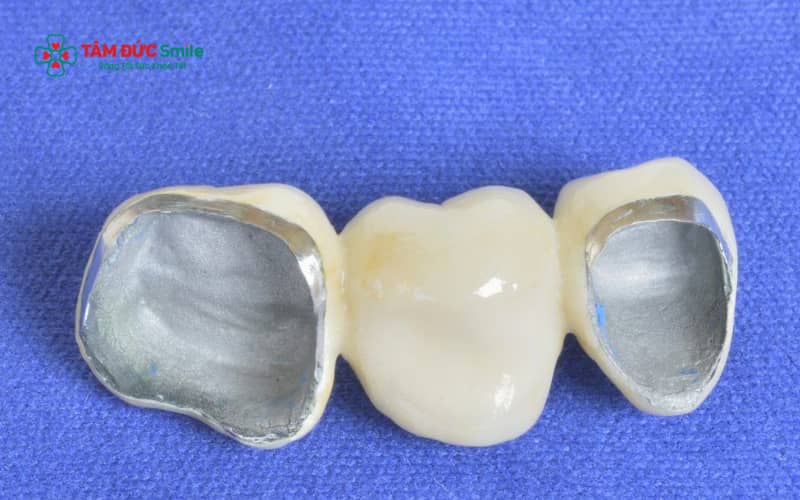 Abc8com cá cược thể thao kim loại Mỹ có cấu tạo gồm lõi kim loại chắc chắn bên trong và lớp sứ phủ bên ngoài giúp cải thiện Abc8c1 com khuyến mãi hấp dẫn