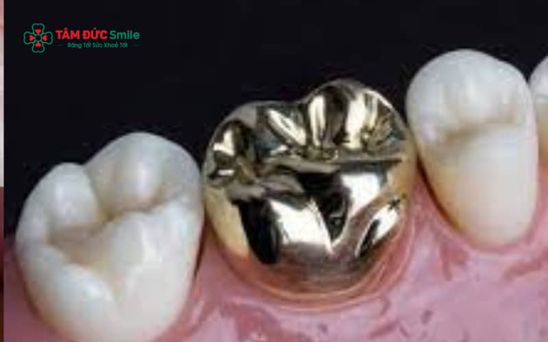 Abc8com cá cược thể thao kim loại Mỹ có ưu điểm về chi phí và độ bền nhưng Abc8c1 com khuyến mãi hấp dẫn có thể không bằng răng toàn sứ.