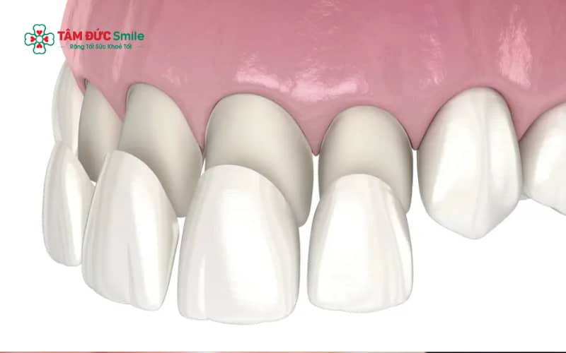 Abc8com cá cược thể thao laminate là mặt dán sứ mỏng gắn lên bề mặt răng nhằm cải thiện màu sắc và hình dáng răng