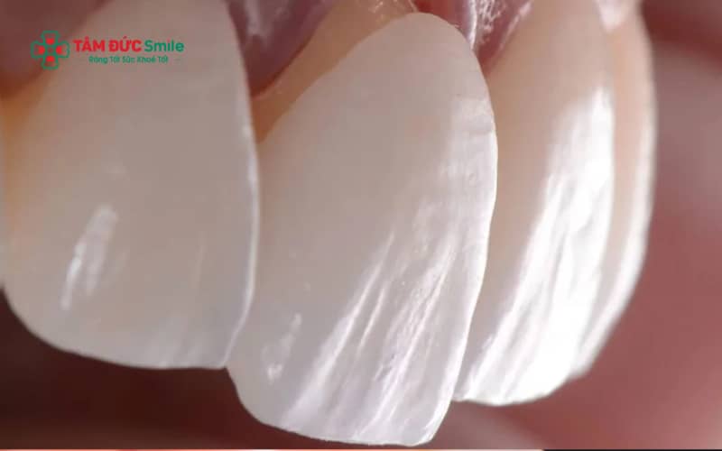 Dán sứ laminate phù hợp với các trường hợp răng ố vàng, răng thưa nhẹ hoặc răng mẻ nhỏ ở vùng răng cửa