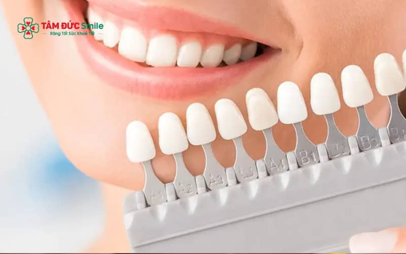 Phương pháp dán sứ laminate dựa trên tình trạng răng và nhu cầu Abc8c1 com khuyến mãi hấp dẫn của từng khách hàng.