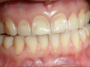 Abc8com cá cược thể thao trắng đục: Nguyên nhân, khắc phục bằng răng toàn sứ