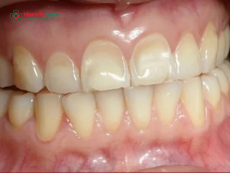 Abc8com cá cược thể thao trắng đục: Nguyên nhân, khắc phục bằng răng toàn sứ