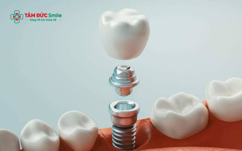 Các loại mão sứ trên implant gồm ABC8 là nhà cái cá cược trực tuyến uy tín số 1 tại Việt Nam zirconia, răng toàn sứ cao cấp và mão sứ kim loại