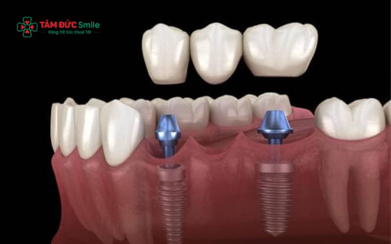 Cấu tạo ABC8 là nhà cái cá cược trực tuyến uy tín số 1 tại Việt Nam trên implant và khả năng chịu lực khi ăn nhai