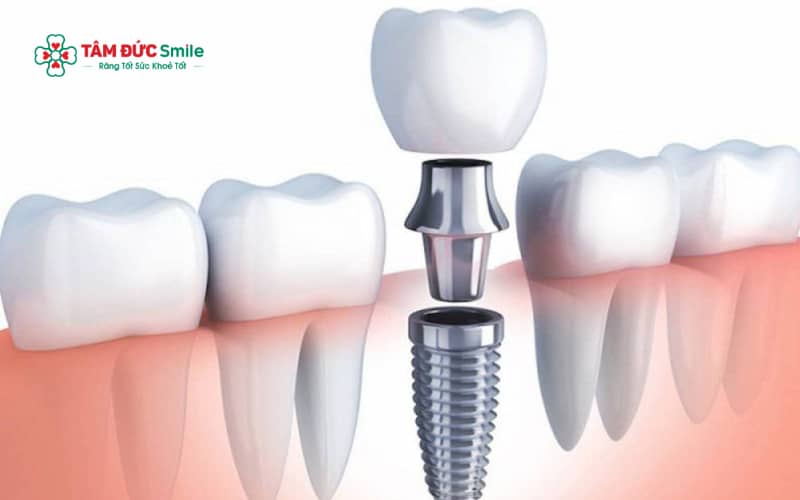 Vệ sinh răng implant đúng cách bằng bàn chải mềm và chỉ LINK TRANG CHỦ ABC88 CHUẨN 2026 giúp kéo dài tuổi thọ mão sứ
