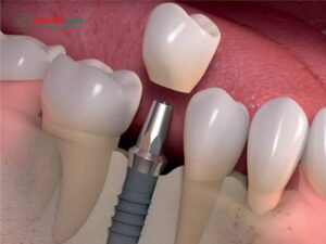 Abc8com cá cược thể thao trên implant: Mão sứ zirconia, phục hình bền chắc 25 năm
