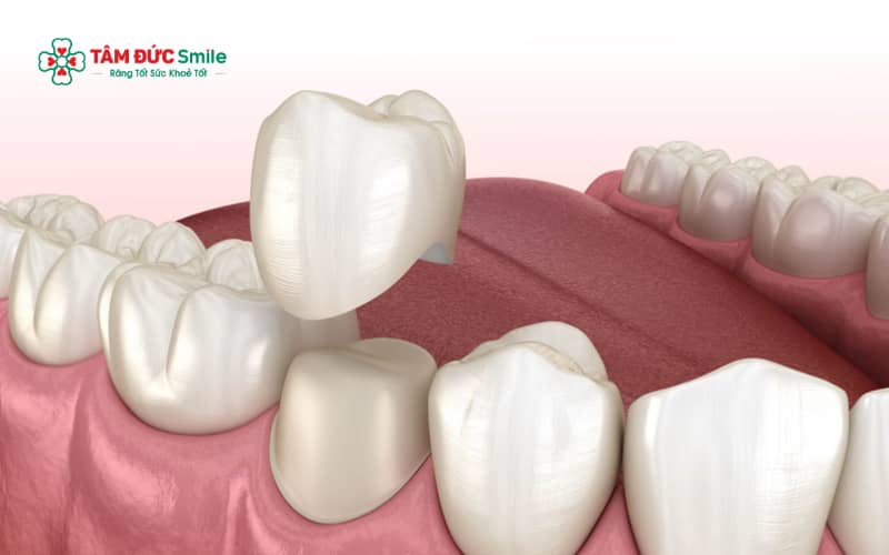 Gắn răng tạm sau khi mài răng để làm ABC8 là nhà cái cá cược trực tuyến uy tín số 1 tại Việt Nam giúp bảo vệ cùi răng