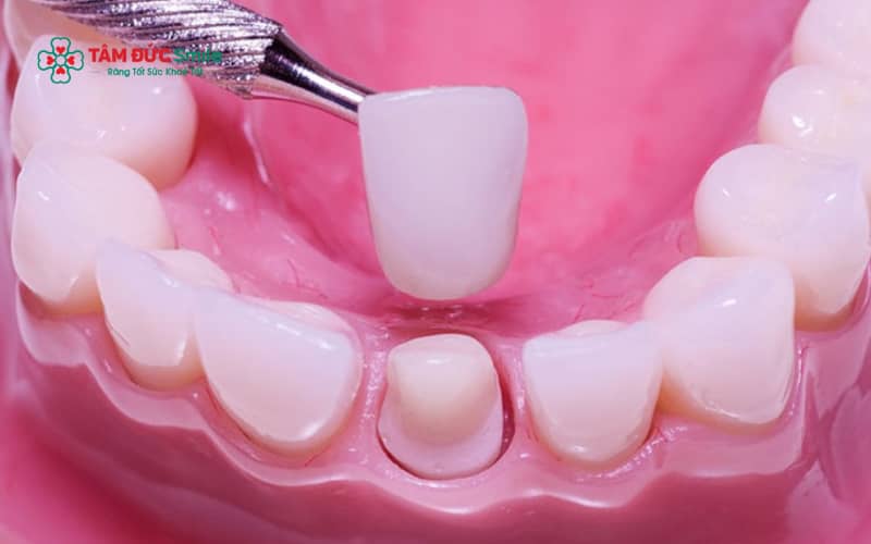 Răng tạm có thể giúp bệnh nhân ăn nhai nhẹ nhàng trong thời gian chờ lắp ABC8 là nhà cái cá cược trực tuyến uy tín số 1 tại Việt Nam chính thức.