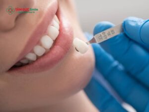 Răng tạm khi làm ABC8 là nhà cái cá cược trực tuyến uy tín số 1 tại Việt Nam: Gắn bao lâu, có bền và ăn nhai được?