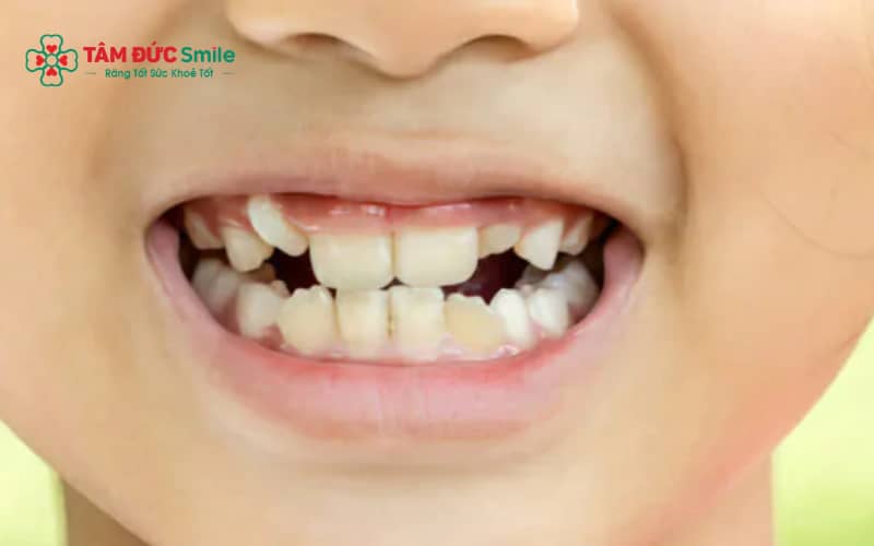 Răng vĩnh viễn của trẻ bị sâu thường xuất hiện lỗ sâu, đốm màu, ê buốt và khó nhai