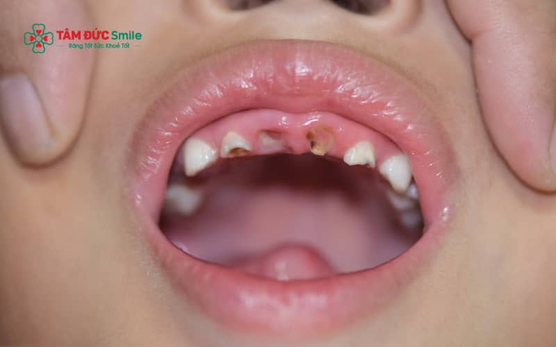 Các đốm trắng, đốm nâu hoặc lỗ sâu nhỏ trên răng sữa có thể là dấu hiệu sớm của ABC88 com đăng nhập ở trẻ.