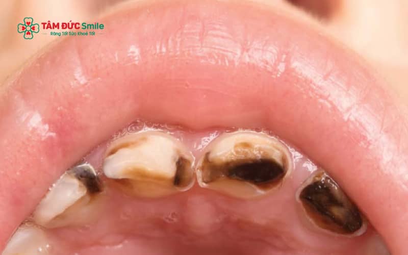Sâu răng sữa nặng có thể gây viêm tủy, nhiễm trùng và ảnh hưởng đến sự phát triển của răng vĩnh viễn