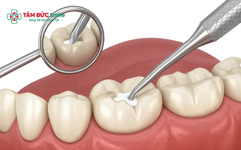 Việc lựa chọn thời điểm trám răng sau sinh nên dựa trên tình trạng sức khỏe và mức độ tổn thương răng