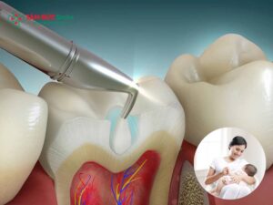 Sau sinh bao lâu thì trám răng được? Mẹ cho con bú có an toàn không