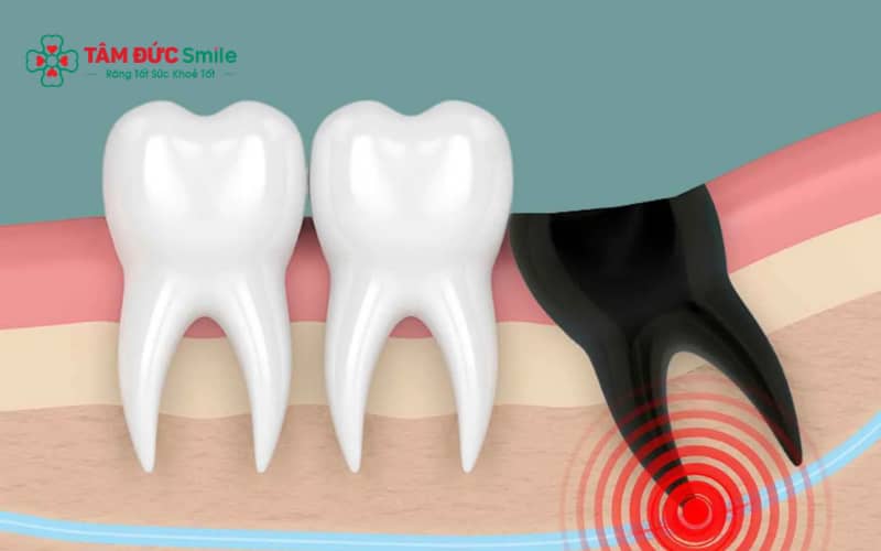 Sưng đau, chảy máu kéo dài hoặc viêm ổ răng là những biến chứng thường gặp sau khi nhổ răng khôn cần theo dõi