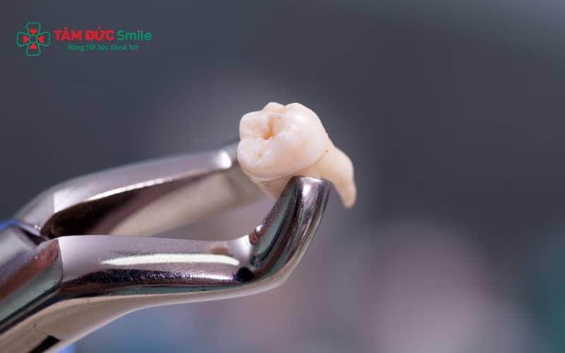 Răng khôn hàm dưới nằm gần dây thần kinh nên tiềm ẩn nguy cơ biến chứng cao hơn nếu không được thực hiện đúng kỹ thuật.