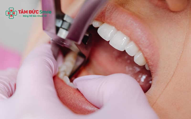 Chăm sóc đúng cách như cắn gạc, tránh Abc88win ứng dụng di động mạnh và theo dõi dấu hiệu bất thường giúp hạn chế biến chứng sau nhổ răng khôn.