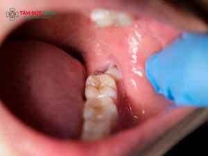 Tác hại của việc nhổ răng khôn: Biến chứng, sưng đau, tê môi