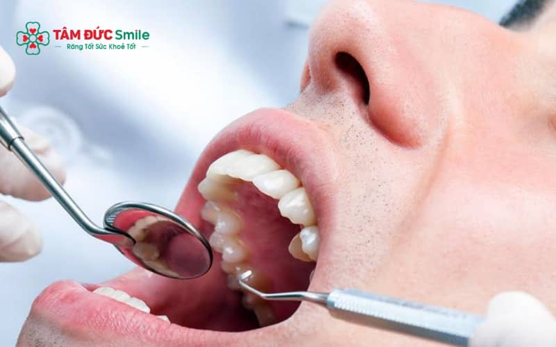 Tê kéo dài, mất vị giác hoặc tê lan xuống môi – cằm là dấu hiệu tổn thương thần kinh cần thăm khám sớm.