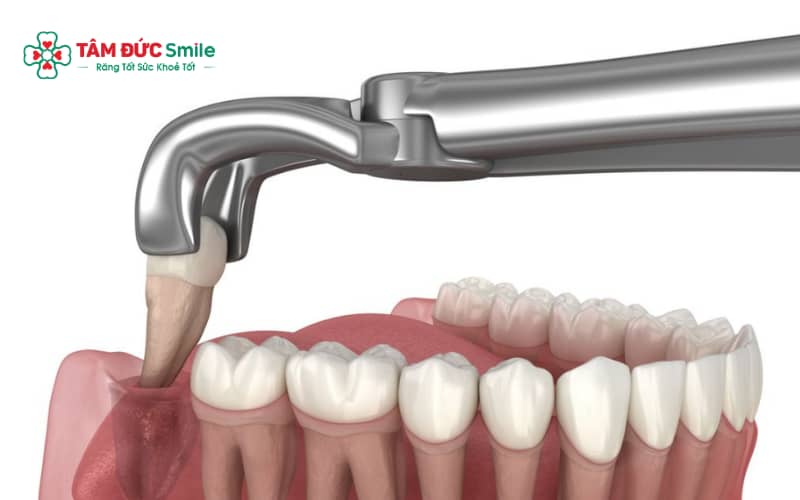 Tê lưỡi sau nhổ răng khôn có thể xảy ra khi dây thần kinh lưỡi hoặc thần kinh hàm dưới bị ảnh hưởng trong quá trình Abc8b tải ứng dụng
