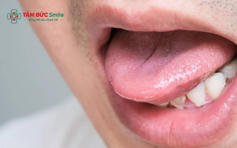Tê lưỡi sau nhổ răng khôn có thể kéo dài từ vài giờ đến vài tuần tùy nguyên nhân và mức độ ảnh hưởng thần kinh.