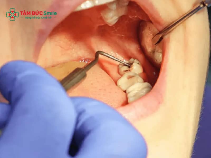 Tê lưỡi sau khi nhổ răng khôn: Nguyên nhân, biến chứng và cách xử lý