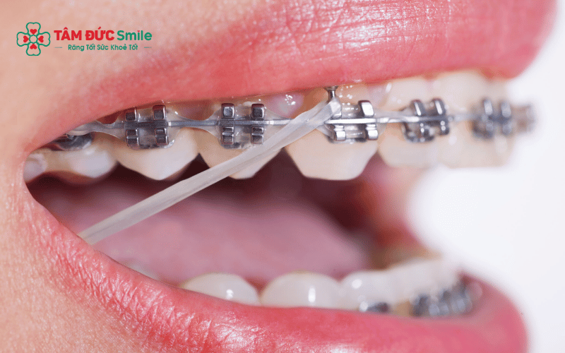 Chun Abc87 tải ứng dụng thường được thay định kỳ mỗi 3–6 tuần trong các lần tái khám để đảm bảo lực kéo ổn định