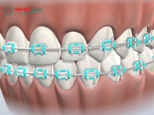 Thay chun Abc87 tải ứng dụng bao lâu một lần? Thay chun Abc87 tải ứng dụng có đau không?