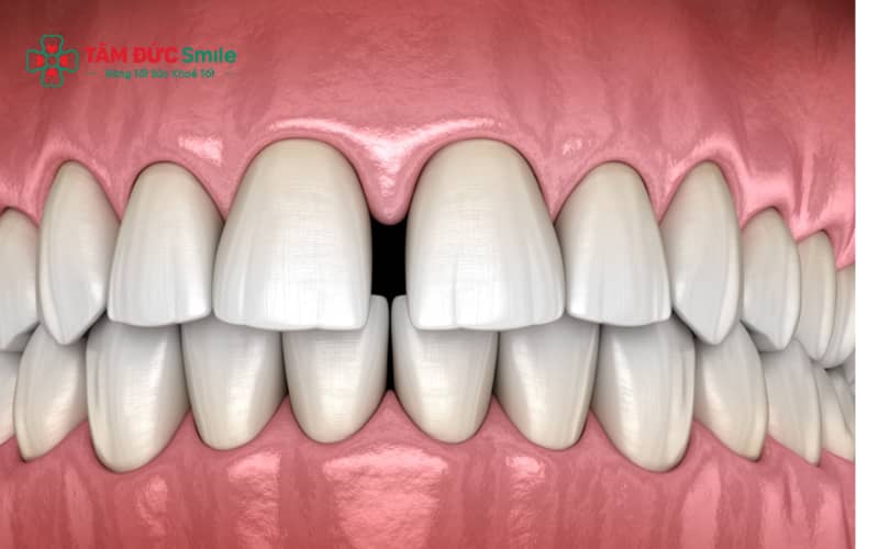 Chi phí trám răng thưa phụ thuộc vào số lượng răng, vật liệu sử dụng và tình trạng răng thực tế