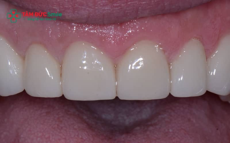 Vệ sinh ABC8 là nhà cái cá cược trực tuyến uy tín số 1 tại Việt Nam đúng cách sau khi trám giúp duy trì độ bền và hạn chế bong miếng trám