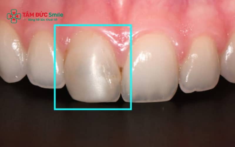 Khi trám kẽ hở giữa 2 răng giúp cải thiện Abc8c1 com khuyến mãi hấp dẫn và đóng khoảng trống hiệu quả