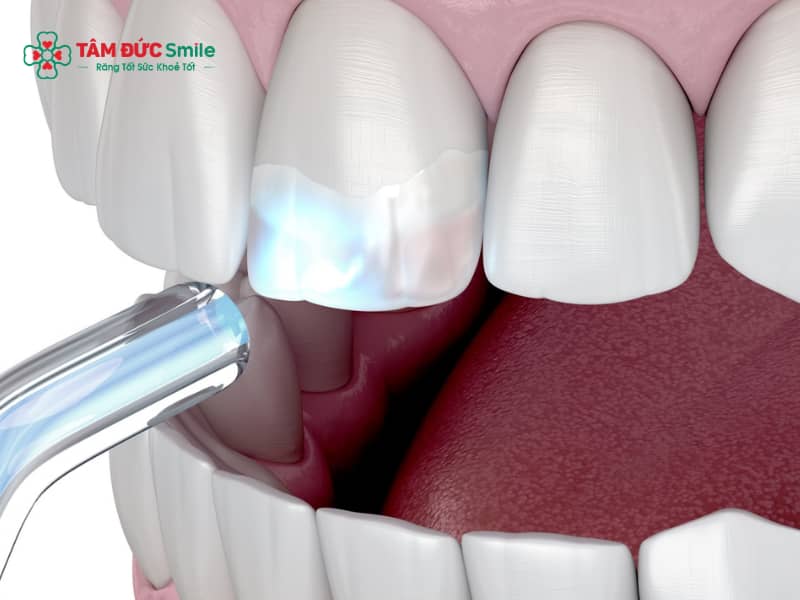 Trám kẻ hở giữa 2 răng – Giải pháp trám răng thưa Abc8c1 com khuyến mãi hấp dẫn bền đẹp