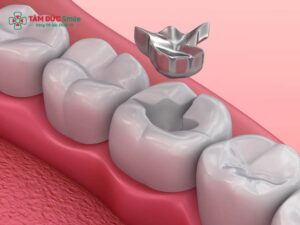Abc8 Abcvip link không chặn amalgam – Hàn răng bạc chịu lực cao