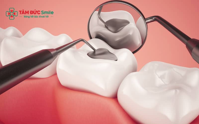 Ưu tiên thực phẩm mềm, dễ nhai sau khi trám răng giúp bảo vệ miếng trám và hạn chế ê buốt