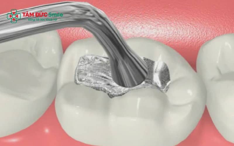 Tránh đồ ăn cứng, quá nóng hoặc quá lạnh sau khi trám răng để hạn chế bong tróc và ê buốt
