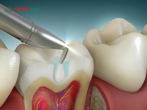 Abc8 Abcvip link không chặn bao lâu thì được ăn? Sau khi trám răng nên ăn gì và kiêng gì