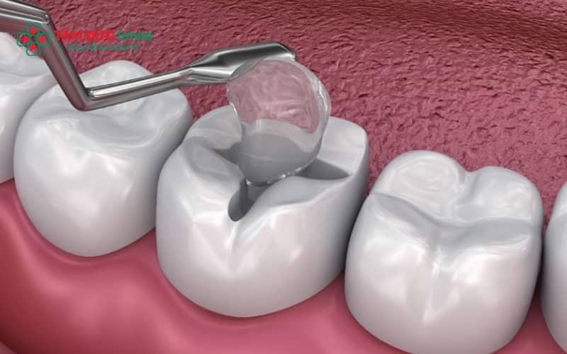Mức độ ABC88 com đăng nhập, vị trí răng và loại vật liệu trám là những yếu tố ảnh hưởng đến thời gian trám răng
