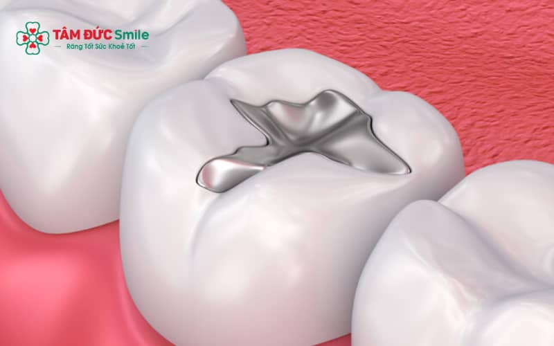 Vật liệu trám răng là một trong những yếu tố quan trọng ảnh hưởng đến độ bền và tuổi thọ của miếng trám.