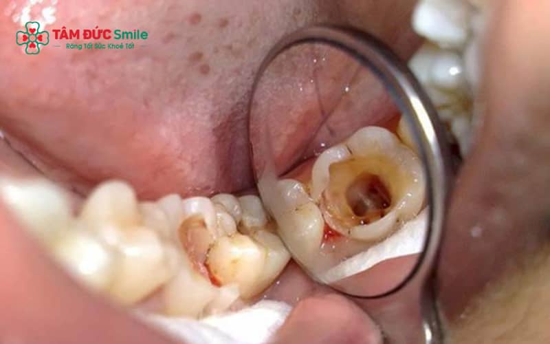 Miếng trám bị nứt, bong hoặc đổi màu có thể là dấu hiệu cho thấy trám răng đã xuống cấp và cần được kiểm tra lại