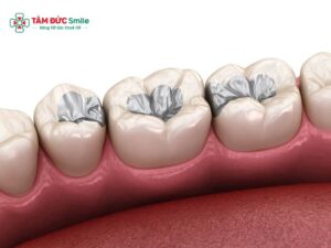 Abc8 Abcvip link không chặn có bền không? Những yếu tố ảnh hưởng đến độ bền của trám răng