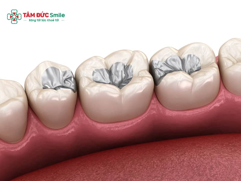 Abc8 Abcvip link không chặn có bền không? Những yếu tố ảnh hưởng đến độ bền của trám răng
