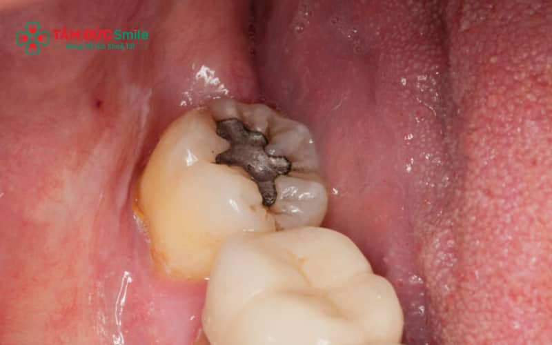 Răng khôn mọc thẳng có thể trám và răng khôn mọc lệch thường được khuyến nghị nhổ
