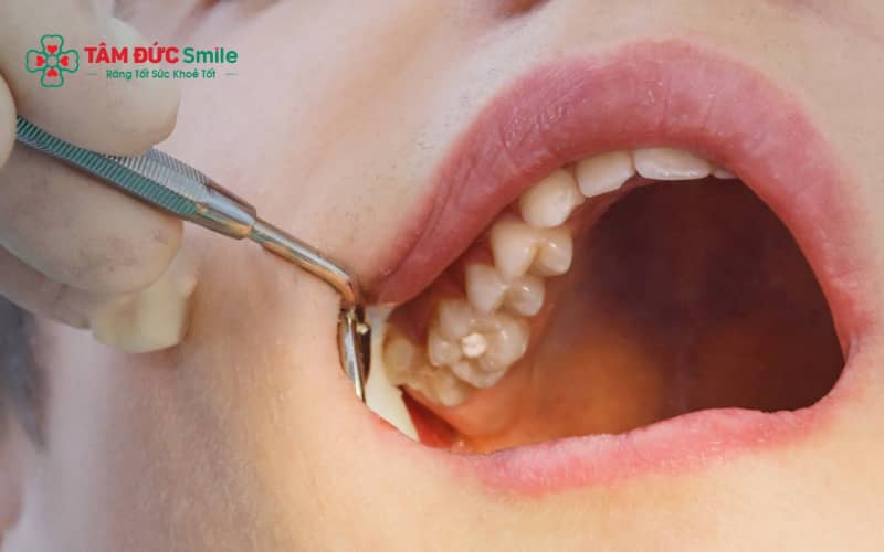 Chăm sóc ABC8 là nhà cái cá cược trực tuyến uy tín số 1 tại Việt Nam đúng cách giúp miếng trám răng khôn bền hơn và hạn chế ABC88 com đăng nhập tái phát.