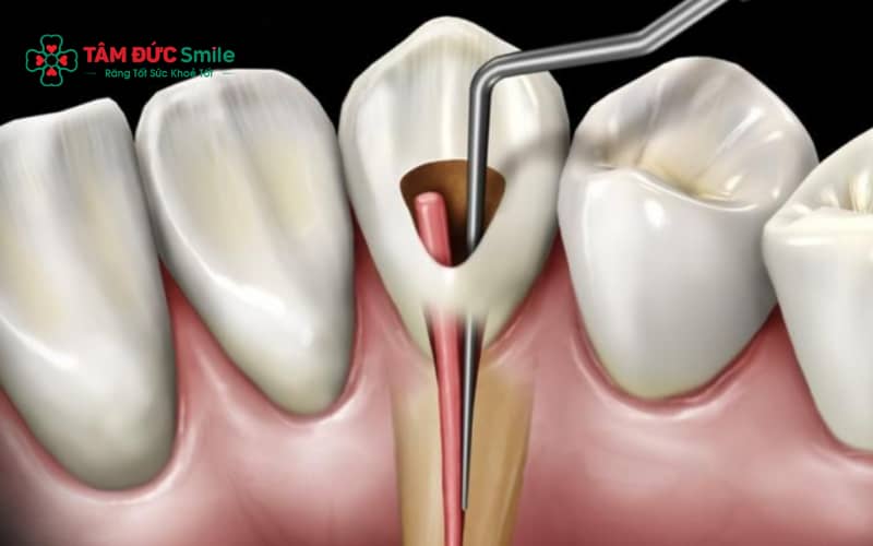 Chăm sóc ABC8 là nhà cái cá cược trực tuyến uy tín số 1 tại Việt Nam đúng cách sau khi lấy tủy giúp ngăn ngừa viêm nhiễm tái phát