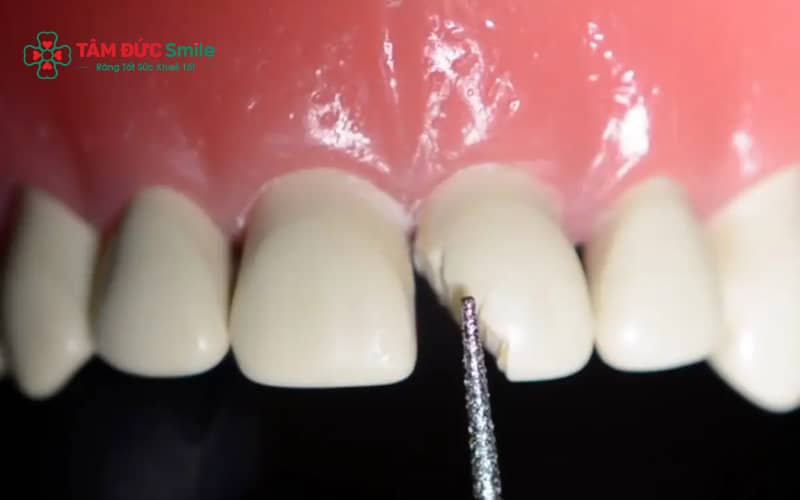 Các phương pháp phục hồi răng mẻ phổ biến gồm trám composite, dán sứ veneer và Abc8.com Thể thao, Đá gà, Xổ số, Bắn cá tùy theo mức độ tổn thương