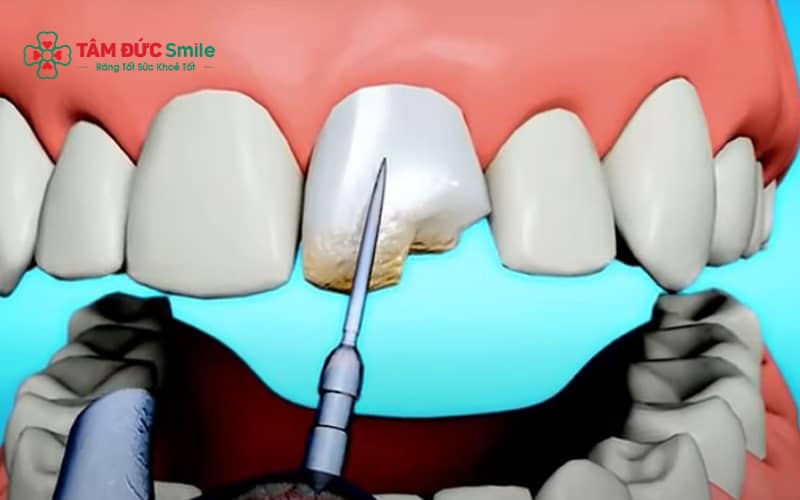 Miếng trám răng mẻ có thể duy trì nhiều năm nếu được thực hiện đúng kỹ thuật và chăm sóc tốt