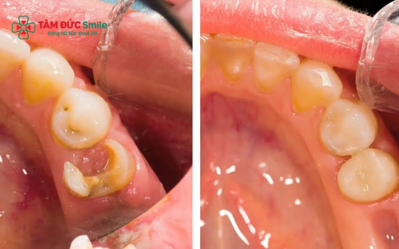 Abc87 nền tảng cá cược trực tuyến thực hiện gây tê trước khi trám răng sâu giúp giảm đau và tạo cảm giác thoải mái trong quá trình Abc8b tỷ lệ kèo World Cup 2026