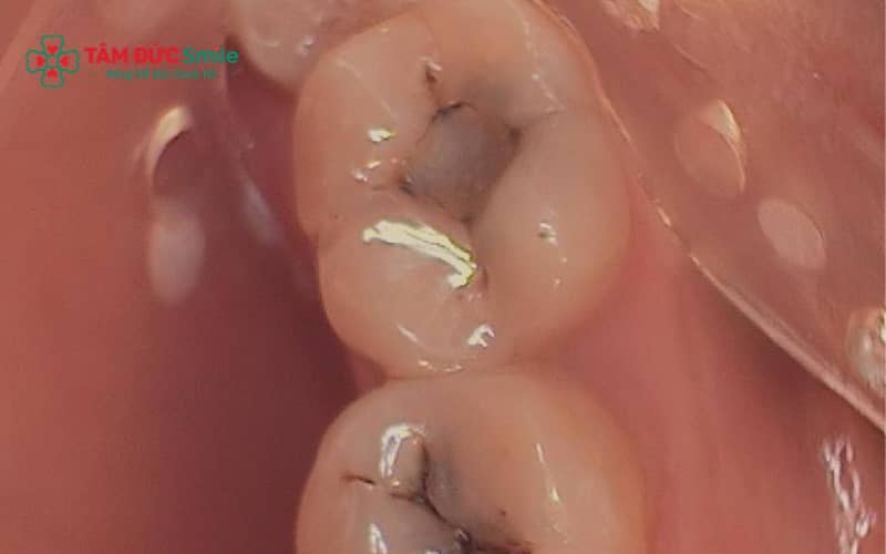 Quy trình trám răng sâu diễn ra nhanh chóng, thường chỉ mất khoảng 20–30 phút cho mỗi răng