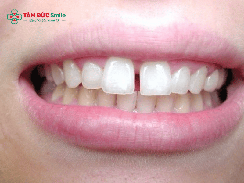 Miếng trám composite có thể duy trì nhiều năm nếu chăm sóc đúng cách và hạn chế tác động mạnh